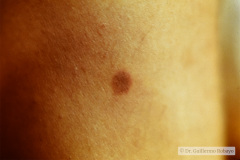 nevus-melanocitico-pequeno-003