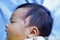 nevus-no-melanocitico-pilosebaseo-001