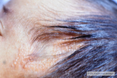 nevus-no-melanocitico-pilosebaseo-003
