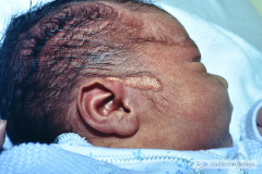 nevus-no-melanocitico-sebaseo-de-jadassohn-graso-preauricular-der-1997-000