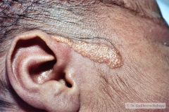 nevus-no-melanocitico-sebaseo-de-jadassohn-graso-preauricular-der-1997-001