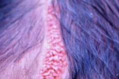nevus-no-melanocitico-sebaseo-de-jadassohn-graso-000