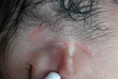 nevus-no-melanocitico-sebaseo-de-jadassohn-suprauricular-2005-000