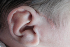 nevus-no-melanocitico-sebaseo-de-jadassohn-suprauricular-2005-003