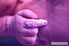 nevus-no-melanocitico-verrugoso-o-epidermico-1992-000