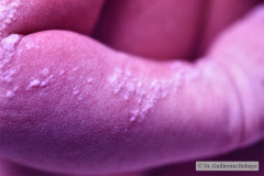 nevus-no-melanocitico-verrugoso-o-epidermico-1992-001