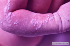 nevus-no-melanocitico-verrugoso-o-epidermico-1992-003