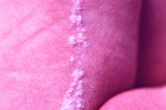 nevus-no-melanocitico-verrugoso-o-epidermico-1992-006