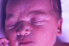 nevus-no-melanocitico-verrugoso-o-epidermico-1992-007