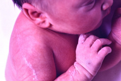 nevus-no-melanocitico-verrugoso-o-epidermico-1992-008