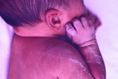 nevus-no-melanocitico-verrugoso-o-epidermico-1992-009