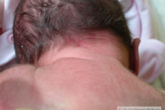 nevus-vino-tinto-flammeus-nucal-000