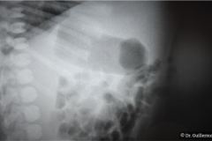 onfalocele-1993-002