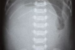 onfalocele-2002-001