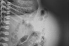 onfalocele-colostomia-doble-boca-1992-000