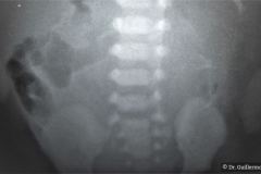 onfalocele-colostomia-doble-boca-1992-002