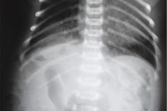 onfalocele-colostomia-doble-boca-1992-004