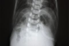 onfalocele-sonda-gastrostomia-1988-000