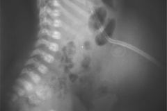 onfalocele-sonda-gastrostomia-1988-001