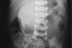 onfalocele-vias-digestivas-000