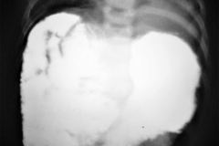 onfalocele-vias-digestivas-001