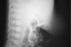 onfalocele-vias-digestivas-003