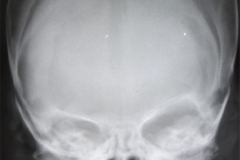 orbita-osea-der-hipoplasica-microftalmia-001