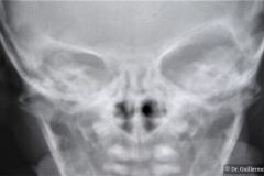 orbita-osea-der-hipoplasica-microftalmia-002
