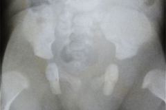 osteogenesis-imperfecta-i-ekman-lobstein-adair-dighton-1994-000
