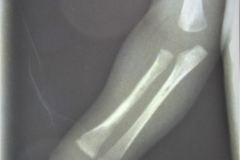 osteogenesis-imperfecta-i-ekman-lobstein-adair-dighton-1994-004