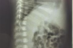 osteogenesis-imperfecta-i-ekman-lobstein-adair-dighton-1994-008