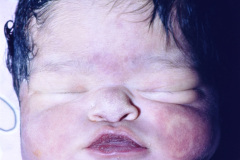 osteogenesis-imperfecta-ii-1994-002