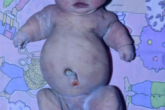 osteogenesis-imperfecta-ii-1994-003