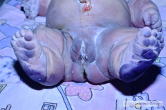 osteogenesis-imperfecta-ii-1994-007