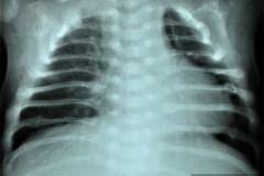 osteogenesis-imperfecta-ii-vrolik-2000-000