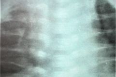 osteogenesis-imperfecta-ii-vrolik-2000-001