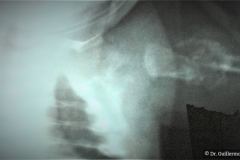 osteogenesis-imperfecta-ii-vrolik-2000-004