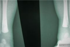 osteomielitis-tibia-izq-metafisis-14d-1986-000