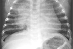 osteopenia-enfermedad-osea-metabolica-eom-raquitismo-osteoporosis-000