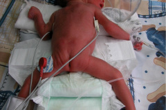 oxigenoterapia-en-prono-camara-cefalica-2002-000
