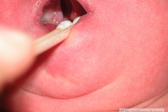 paladar-hendido-central-uvula-bifida-000