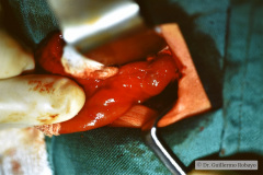 pancreas-anular-atresia-duodenal-1987-000