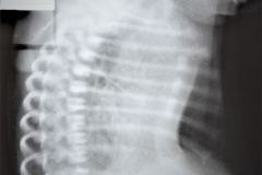 pectus-excavatum-torax-escavado-000