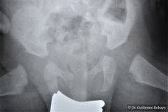 pelvis-normal-medicion-agulos-acetabulares-000