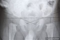 pelvis-normal-medicion-agulos-acetabulares-001