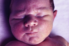 pena-shokeir-i-hipoquinesia-fetal-artrogriposis-1989-003