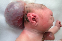 pentalogia-cantrell-2005-006