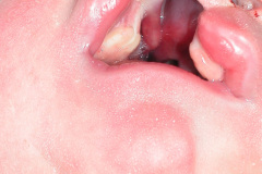 pentalogia-cantrell-2005-017