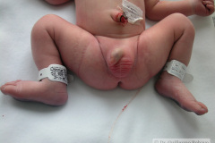 pentalogia-cantrell-2005-021