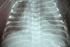 perforacion-gastrica-estomago-pleuritis-derrame-pleural-izq-001
